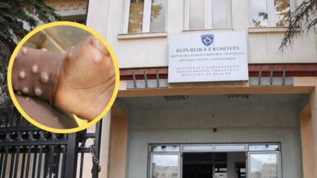 IKSHPK: Kosova’da ‘Maymun Çiçeği’ Vakası Yok